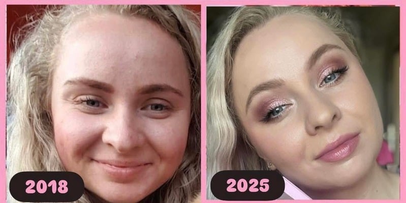 Proměna pleti Kristýny Markové — srovnání 2018 a 2025
